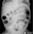 Necrotizing Enterocolitis